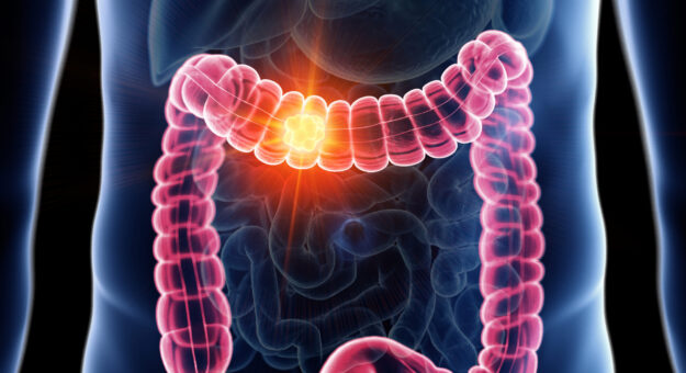 cáncer colon