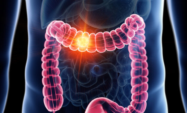 cáncer colon cáncer colon